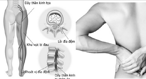 Nguyên nhân gây đau thần kinh tọa chủ yếu do tổn thương hoặc đĩa đệm thoát vị.