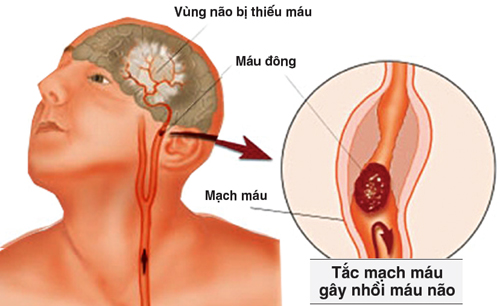 Tắc mạch não - Một nguyên nhân gây nhồi máu não.