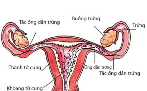 Viêm tắc vòi trứng là một nguyên nhân hiếm muộn.