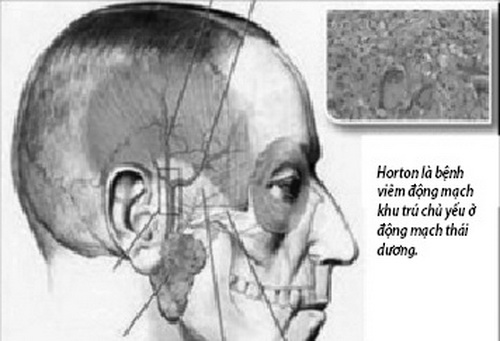 Horton là bệnh viêm động mạch khu trú chủ yếu ở động mạch thái dương.
