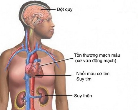 Các biến chứng của tăng huyết áp.