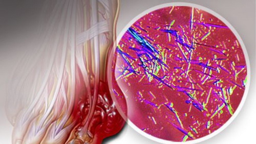 Hình ảnh mô phỏng tăng acid uric và bệnh Gout.