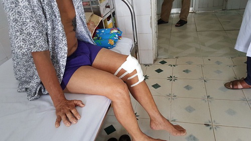Ông Vũ Trung Thạnh đã hồi phục tốt sau thay khớp gối bán phần. Ông Vũ Trung Thạnh đã hồi phục tốt sau thay khớp gối bán phần.