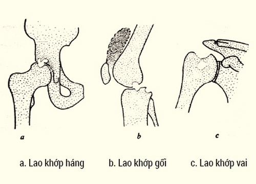 Bệnh Lao Xương Lây Qua Đường Nào?