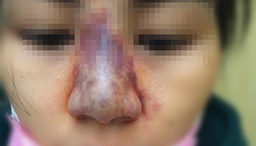 Một trường hợp tím bầm mũi sau bơm filler nâng mũi.