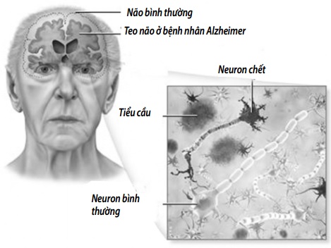 Teo não bệnh nhân sa sút trí tuệ.