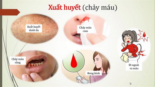 Các dấu hiệu nhận biết sốt xuất huyết.