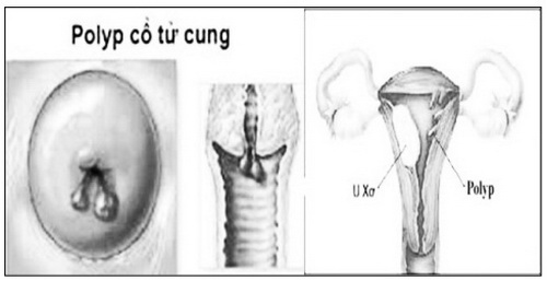 Hình ảnh polyp cổ tử cung.