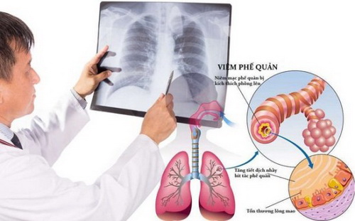 Viêm phế quản là một điều kiện đưa đến bệnh phổi tắc nghẽn mạn tính (COPD).