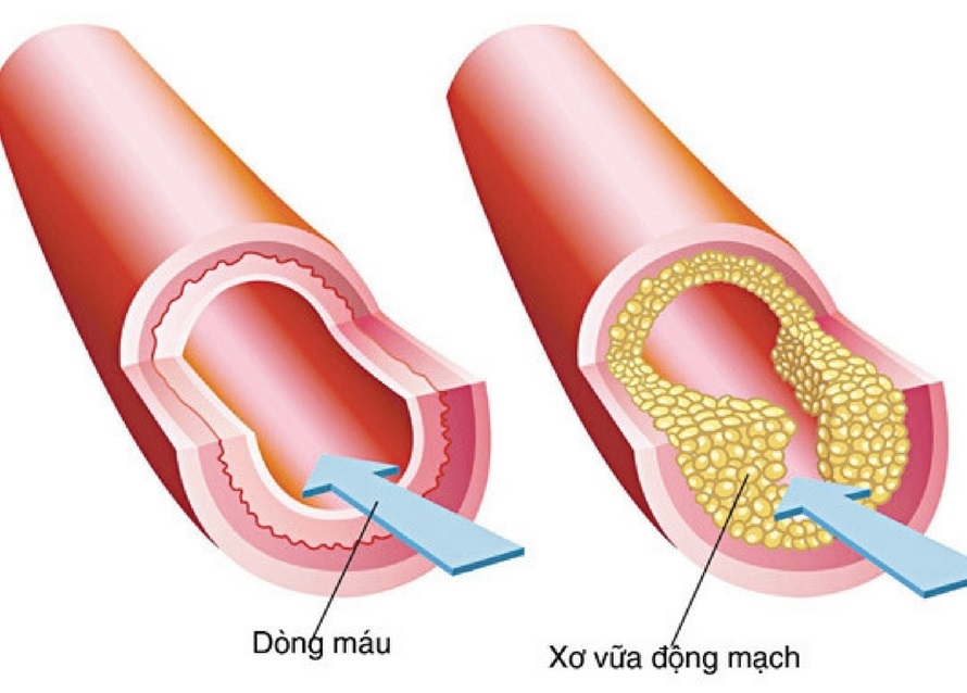 Những người bị viêm khớp dạng thấp cho thấy tăng nhanh xơ vữa động mạch.