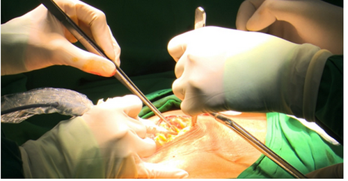 Ê kíp phẫu thuật kết hợp thủ thuật MWA phá hủy u gan cho bệnh nhân.