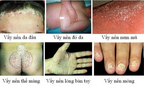 Các hình thái vảy nến.