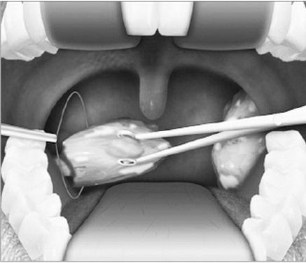 Việc cắt amidan phải có chỉ định của bác sĩ, căn cứ vào tình trạng bệnh lý.