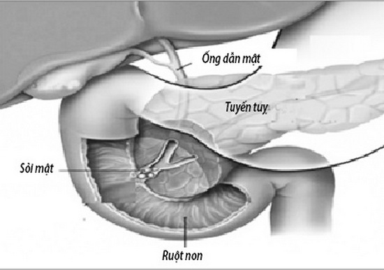 Sỏi mật là một trong những nguyên nhân gây viêm tụy cấp.