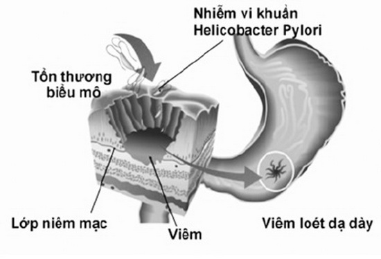 Nhiễm vi khuẩn HP gây viêm loét dạ dày.