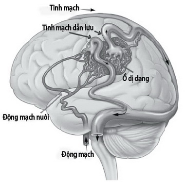 Dị dạng mạch máu - một nguyên nhân gây đau đầu.