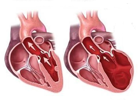 Nhận biết và phòng ngừa bệnh thấp tim