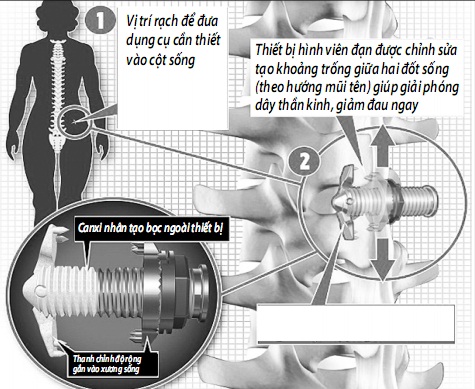 Thiết bị hình viên đạn được cấy ghép vào cột sống giúp giảm đau do hẹp ống sống.