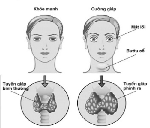 Bướu cổ - Một hệ lụy do thiếu i-ốt.