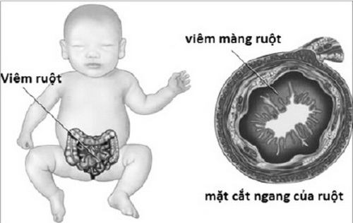 Trẻ bị viêm ruột dễ dẫn đến hấp thu và tiêu hóa kém.