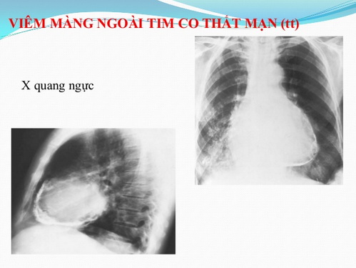 Viêm màng ngoài tim do co thắt mạn.