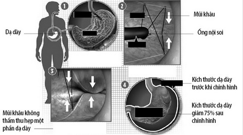 Phẫu thuật nội soi thu nhỏ dạ dày.