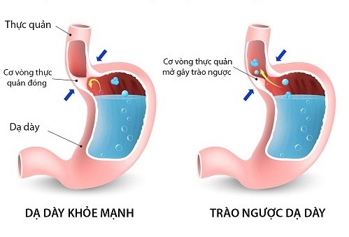 Hình ảnh dạ dày khỏe và bị trào ngược.