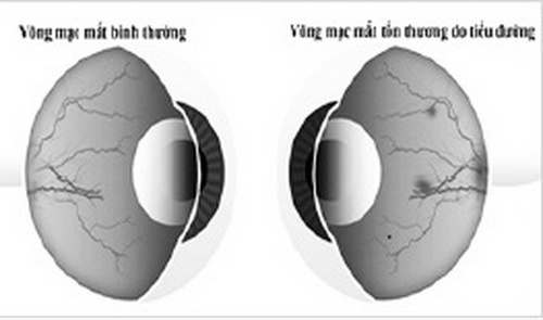 Hình ảnh mắt tổn thương do tiểu đường.