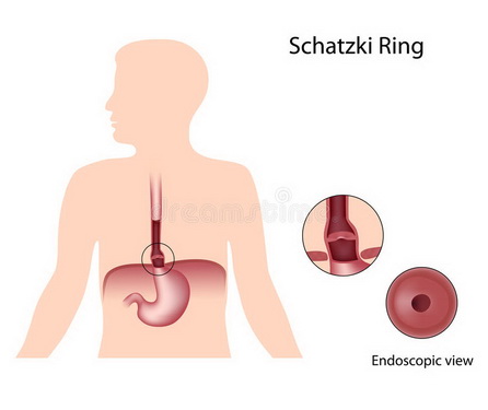 Vòng Schatzki gây khó nuốt cho bệnh nhân. Vòng Schatzki gây khó nuốt cho bệnh nhân.