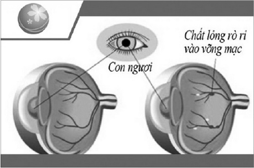 Bệnh võng mạc do tiểu đường dễ dẫn đến mù lòa.