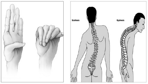 Hội chứng Marfan có thể biểu hiện: cao bất thường, chân tay dài, bàn chân phẳng, rộng