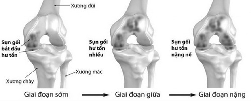 Các giai đoạn của thoái hóa khớp gối.