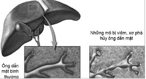 Viêm xơ đường mật có thể dẫn đến những biến chứng nguy hiểm.
