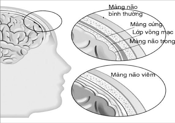 Biến chứng viêm màng não do giun lươn.