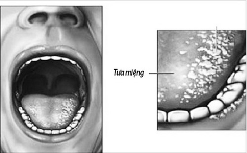 Tưa miệng - một tác dụng phụ thường gặp khi dùng steroid dạng hít kéo dài.