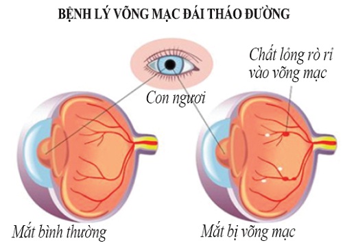 Bệnh lý võng mạc do ĐTĐ.