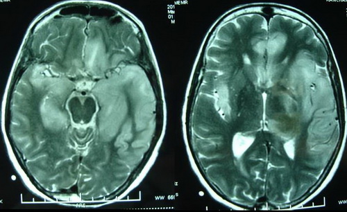 Hình ảnh MRI não điển hình của bệnh viêm não do virut Herpes.