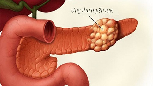 Dấu hiệu sớm ung thư tuyến tụy