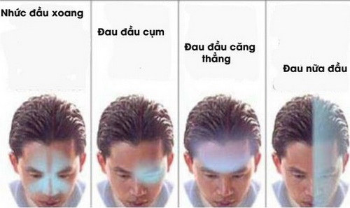 Các dạng đau đầu thường gặp.