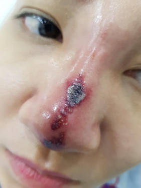 Biến chứng do tiêm filer mũi từ các tiệm spa chăm sóc da.