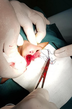 Biến chứng nâng mũi bằng chỉ phải phẫu thuật lại.