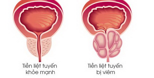 Viêm tuyến tiền liệt - Một nguyên nhân khiến nam giới đau khi yêu.