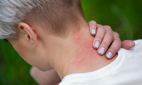 Những người mắc hội chứng skeeter có xu hướng thu hút muỗi nhiều hơn những người khác.