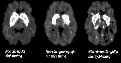 Ma túy đá hủy hoại não của người sử dụng.