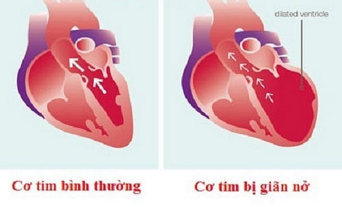 Hình ảnh cơ tim giãn trên siêu âm.