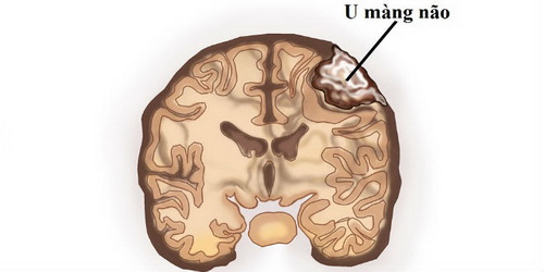 Nguy cơ cao xuất hiện u màng não ở phụ nữ có dùng cyproteron trên 6 tháng.