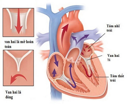 Nguy cơ do hở van động mạch chủ.