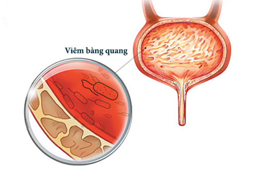 Viêm bàng quang - Một nguyên nhân gây tiểu nhiều.