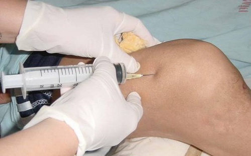 Lạm dụng tiêm khớp có thể gây ra nhiều biến chứng khó lường, để lại hậu quả nghiêm trọng, đáng tiếc.