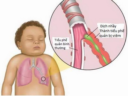 Trời lạnh, trẻ em càng dễ bị viêm phế quản.